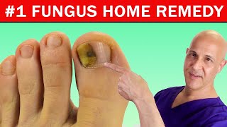 1 Best Home Remedy Cure for Toenail Fungus Dr Mandell [upl. by Ramyaj]