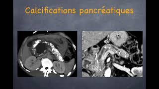 Pancréatite chronique  1 Diagnostic positif [upl. by Fedak]