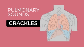 Crackles or Crepitations  Quick amp Easy Overview Easy Lung Sounds [upl. by Shig]