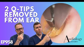 2 QTIPS REMOVED FROM EAR  EP958 [upl. by Virgy]