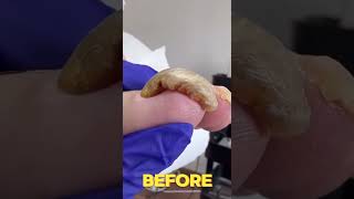 The Most Incredible Nail Correction Transformation 2024 [upl. by Yeuh4]