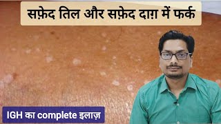 सफ़ेद तिल और सफ़ेद दाग़ में फर्क  Idiopathic Guttate Hypomelanosis  IGH vs Vitiligo vitiligo igh [upl. by Finnigan]