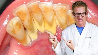 Dentist Explains TOOTH PAIN AFTER DEEP CLEANINGS Sensitive Teeth Gums Ache amp Severely Hurt [upl. by Adnov]