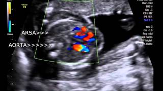 ARSA  aberrant Right subclavian artery in fetus 18 weeks [upl. by Yuhas]