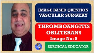 THROMBOANGITIS OBLITERANS  VASCULAR SURGERY  Image Based Question [upl. by Etteroma]