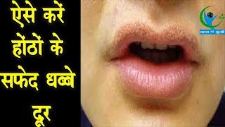 होठों से सफ़ेद धब्बे दूर करने के ये हैं आसान घरेलू उपाय…  Home Remedies for White Spots on Lips [upl. by Fen268]