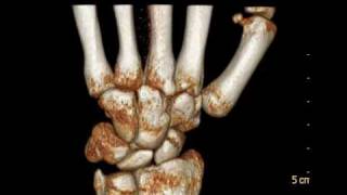 CTTC Multislice  Wrist Fracture  Fratura Punho  scaphoid [upl. by Eirek]