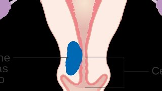 MNEMONIC  Risk Factors of Endometrial Cancer [upl. by Eytak]