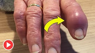 Stop Suffering From Swollen Finger Joint Proven Treatment Options and Prevention Tips [upl. by Devlin]