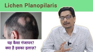 Lichen Planopilaris  यह कैसा गंजापन क्या है इसका इलाज़ Lichen Planus lichenplanus alopecia [upl. by Idzik]