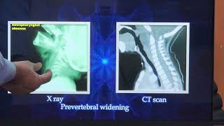 Acute Retropharyngeal Abscess  Tamil  Patient teaching programme [upl. by Gainer]