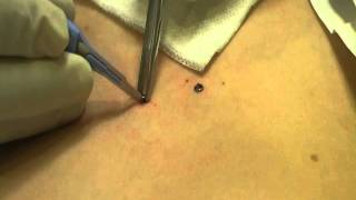 Microdermal Dermal Anchor Removal at MediZen Cosmetic Clinic Birmingham UK [upl. by Modern]