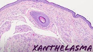 Xanthelasma xanthoma of eyelid yellow bumps around eye pathology dermpath dermatology [upl. by Lyreb]