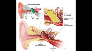 Ear Infection  Middle ear infection  noorpharmacylectures8513 [upl. by Riannon]