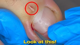 How They Remove An Ingrown Toenail 2024 [upl. by Aniraz223]