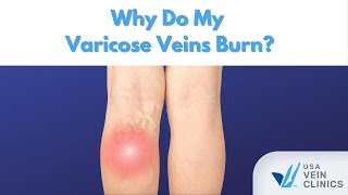 Why Do My Varicose Veins Burn [upl. by Nadabb296]