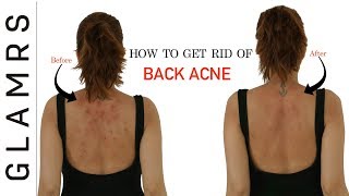 How To Get Rid of Back Acne the Natural Way  Effective Home Remedies [upl. by Dill358]