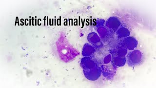 Ascitic fluid analysis  biochemical and cytological evaluation [upl. by Sinnylg]