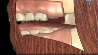 How Myobrace Works What are the causes of crooked teeth Myobrace [upl. by Euqinay]