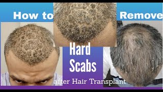 How to remove Hard Scabs after Hair Transplant  KV Hair Care amp Life [upl. by Ahsien]