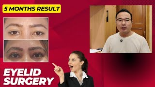 Eyelid surgery thaa 5 gi result and yet oi manadabei discussion [upl. by Arber207]