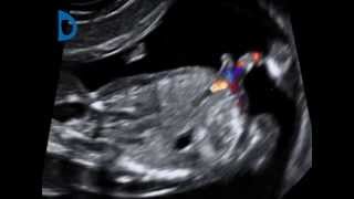 Fetal Medicine Foundation  umbilical cord duplication at 12 weeks [upl. by Ayimat]