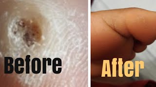 Plantar Wart treatment  Update Part 2 [upl. by Gagnon]