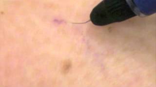 Spider veins being treated by VeinGoghs Ohmic Thermolysis System [upl. by Manvell]