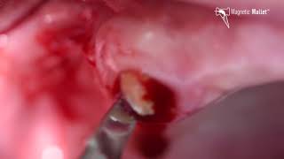 Ankylosed tooth extraction using the MAGNETIC MALLET [upl. by Odyssey]