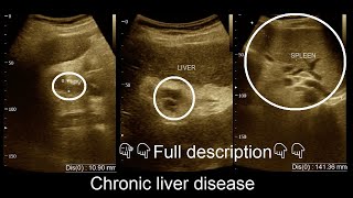 CLD  Chronic liver disease  Ultrasound  Report  Amader hospital  আমাদের হাসপাতাল [upl. by Dammahom]