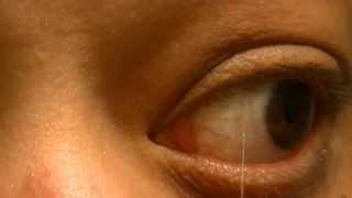 Morgellons Eye Disease Strings in Eyes [upl. by Brufsky843]