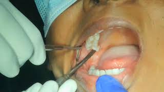 using periosteal elevator to remove 3 wisdom molars in single visit [upl. by Reinaldos]