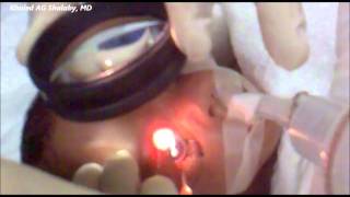 Laser Treatment of Retinopathy of prematurity ROP [upl. by Cinimod]