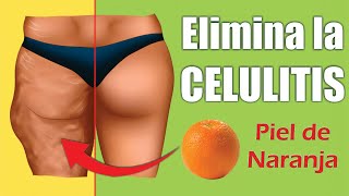 CELULITIS o LIPODISTROFIA 🍊 ¿Cómo ELIMINAR la PIEL de NARANJA 👙 Dr ALBERTO CALVO QUIROZ [upl. by Dicks]