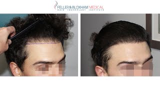 FUE Hair Transplant Gone Wrong Can it be Fixed  Dr Bloxham  Feller amp Bloxham NY NYC LI [upl. by Dohsar2]