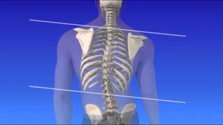 Scoliosis  Curvature of the Spine [upl. by Eiffub]