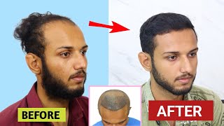 5 Month amazing hair transplant results  100 Natural hair  best hair transplant in india 2024 [upl. by Schoenfelder]