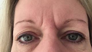 Hooded Eye Lids  Plasma Pro  Plasma Blast  Fibroblast [upl. by Marler]