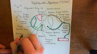 Progressive Encephalomyelitis with Rigidity and Myoclonus PERM Part 2 [upl. by Kinghorn]