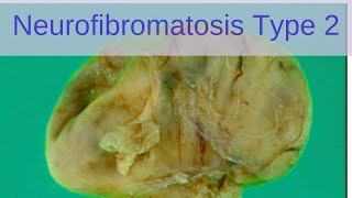 Neurofibromatosis Type 2 NF2  Pathology mini tutorials [upl. by Adnomal328]