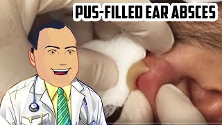 PusFilled Ear Abscess Drained  Revisited Popping [upl. by Richma]