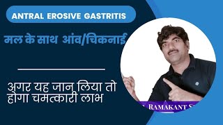 erosive antral gastritis  पेट फूलना आंव चिपचिपा मल आना [upl. by Lalittah]