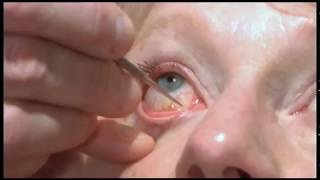 Oculoplastics basic exam Lacrimal system examination [upl. by Aniteb]