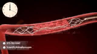 Mechanical Thrombectomy  Neurovascular stent deployment [upl. by Sela]