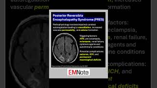 Posterior Reversible Encephalopathy Syndrome PRES doctor medical nursing [upl. by Egiap]