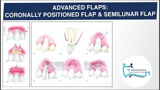 ADVANCED PEDICLE FLAPS CORONALLY POSITIONED FLAP SEMILUNAR FLAP ROOT COVERAGE DR ANKITA [upl. by Thedric]