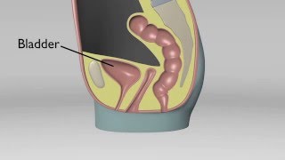 Cystocele No Uterus [upl. by Anielram]