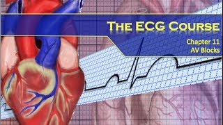 The ECG Course  AV Blocks [upl. by Oshinski]