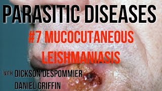 Parasitic Diseases Lectures 7 Mucocutaneous Leishmaniasis [upl. by Taveda976]