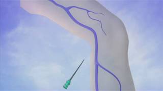 Part 4 Thermal Ablation Diagnosis and Treatment of Varicose Veins [upl. by Domph537]